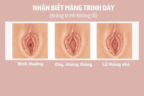 mang-trinh-day-la-gi (2)