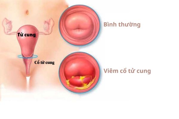 canh-giac-voi-benh-phu-khoa-va-loi-khuyen-ve-suc-khoe-3