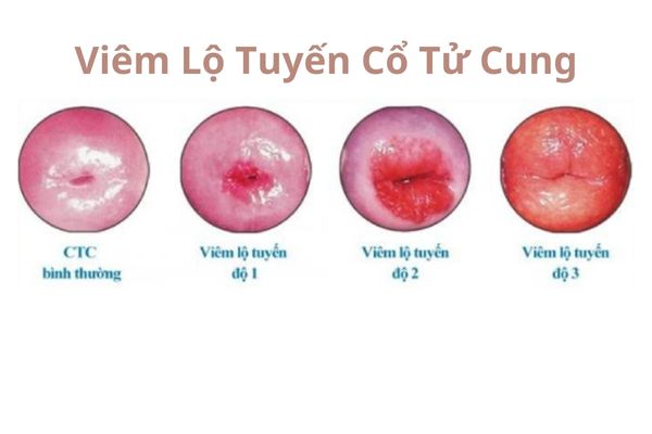 canh-giac-voi-benh-phu-khoa-va-loi-khuyen-ve-suc-khoe-4