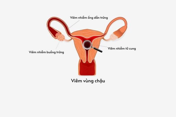 canh-giac-voi-benh-phu-khoa-va-loi-khuyen-ve-suc-khoe-6