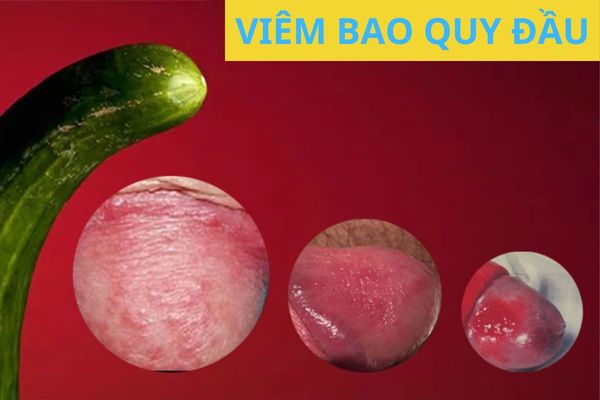 dieu-tri-viem-bao-quy-dau-ngay-truoc-khi-qua-muon-1