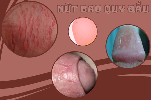 nut-bao-quy-dau-khong-nen-xem-thuong-1