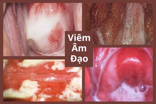 vung-kin-co-mang-trang-la-bi-gi-va-dieu-tri-ra-sao-2