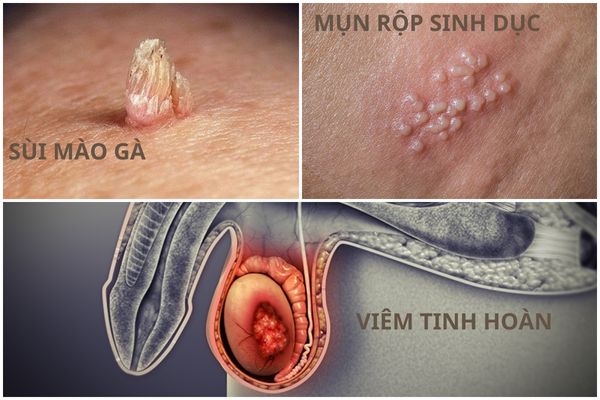 dung-bo-qua-tinh-trang-mun-tinh-hoan-2