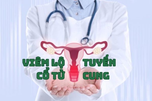 Thông tin cần biết về bệnh viêm lộ tuyến cổ tử cung