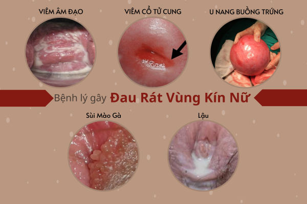 chua-dau-rat-vung-kin-nu-nhu-the-nao-va-o-dau-hieu-qua-1