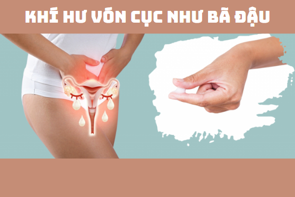 Khí hư vón cục như bã đậu là bị gì?