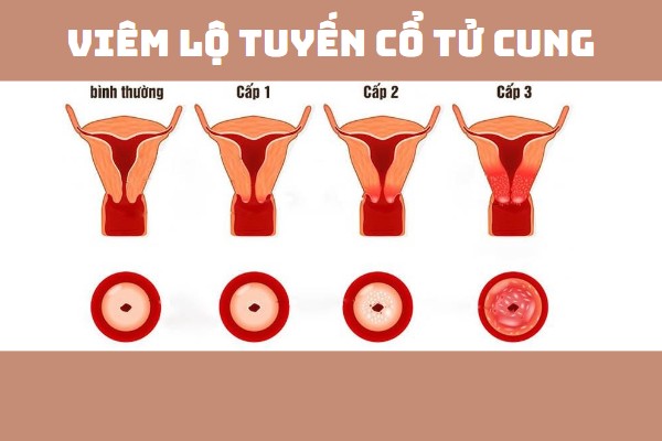 khi-hu-von-cuc-nhu-ba-dau-la-bi-gi-2