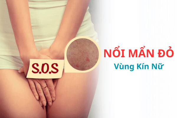 Nguyên nhân và cách trị nổi mẩn đỏ vùng kín nữ