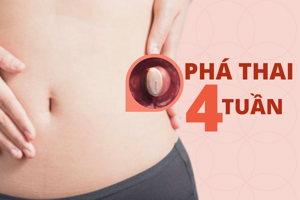 Thực hiện phá thai 4 tuần an toàn như thế nào?