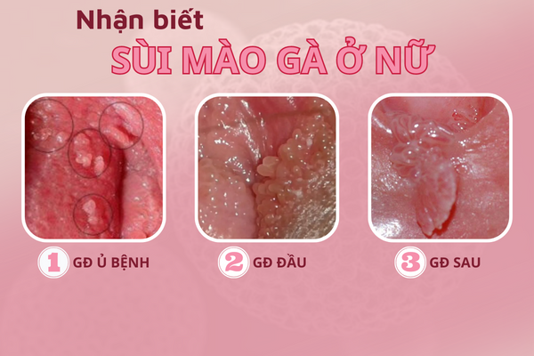 bao-dong-do-ve-sui-mao-ga-o-nu-2
