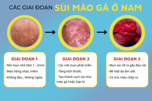 canh-bao-benh-sui-mao-ga-o-nam-gioi-2