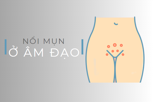 Đừng chủ quan khi bị nổi mụn ở âm đạo