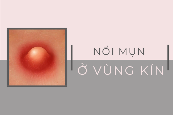 Hết sức cẩn trọng với nổi mụn ở vùng kín