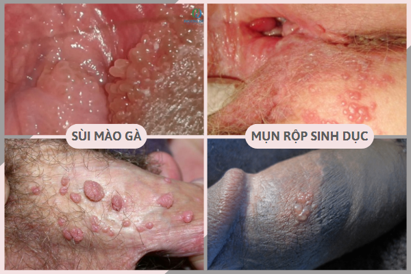het-suc-can-trong-voi-noi-mun-o-vung-kin-01