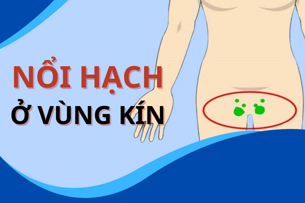 Nổi hạch ở vùng kín là do đâu?