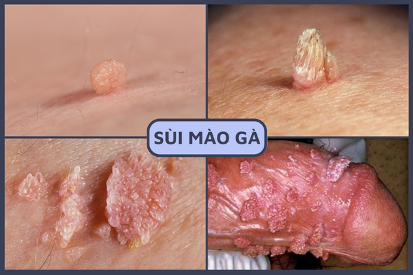 noi-mun-o-duong-vat-la-bi-gi-1