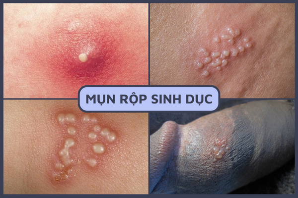 noi-mun-o-duong-vat-la-bi-gi-2