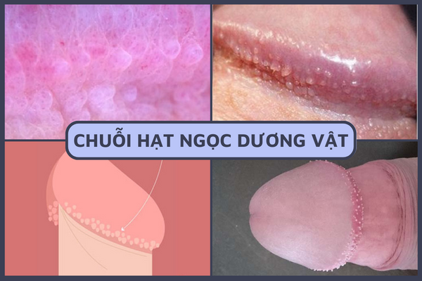 noi-mun-o-duong-vat-la-bi-gi-3