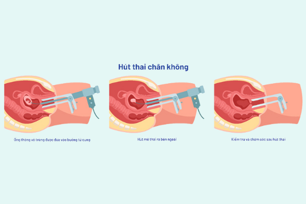 pha-thai-3-thang-con-an-toan-khong-2