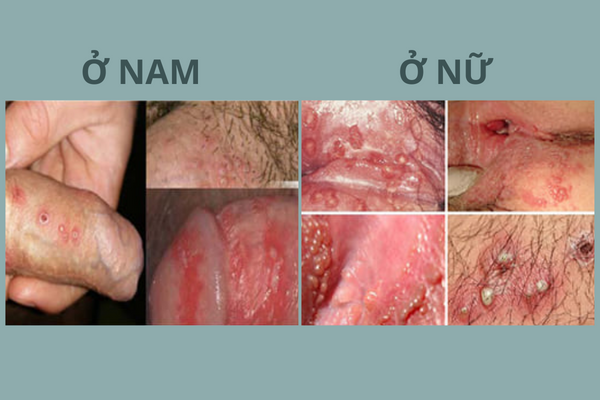 tong-hop-thong-tin-huu-ich-ve-mun-rop-sinh-duc-3