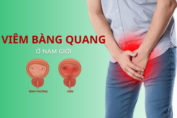 Chú ý căn bệnh viêm bàng quang ở nam giới