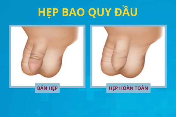 diem-danh-cac-benh-o-bao-quy-dau-thuong-gap-02