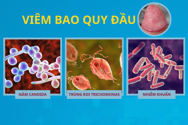 diem-danh-cac-benh-o-bao-quy-dau-thuong-gap-3