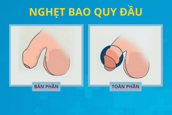 diem-danh-cac-benh-o-bao-quy-dau-thuong-gap-4