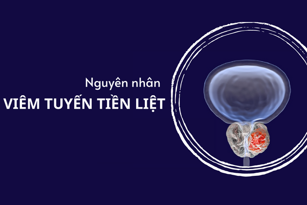 Điểm danh các nguyên nhân viêm tuyến tiền liệt
