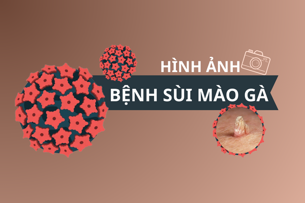 Hình ảnh bệnh sùi mào gà ở vị trí khác nhau trên cơ thể
