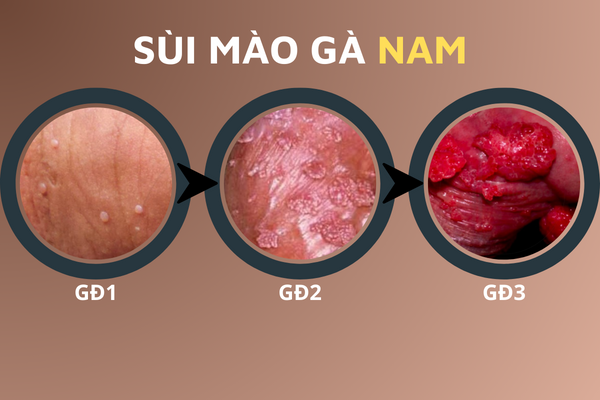 hinh-anh-benh-sui-mao-ga-o-vi-tri-khac-nhau-tren-co-the-2