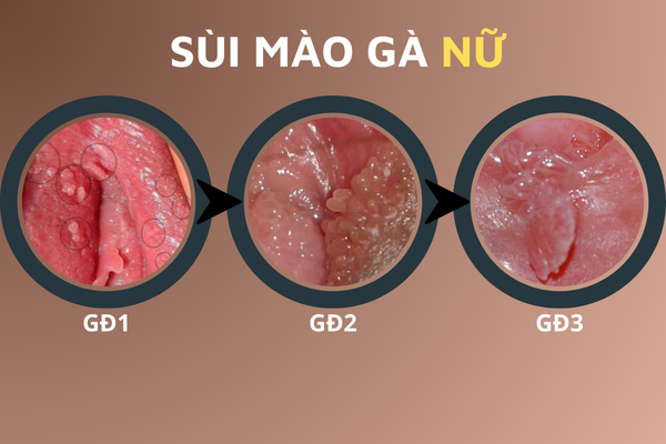 hinh-anh-benh-sui-mao-ga-o-vi-tri-khac-nhau-tren-co-the-3