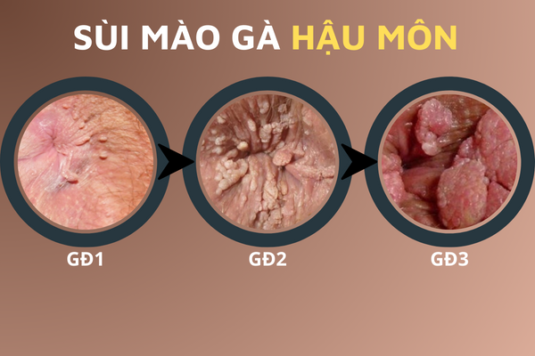 hinh-anh-benh-sui-mao-ga-o-vi-tri-khac-nhau-tren-co-the-4