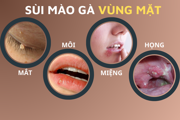 hinh-anh-benh-sui-mao-ga-o-vi-tri-khac-nhau-tren-co-the-5