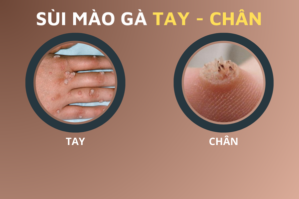 hinh-anh-benh-sui-mao-ga-o-vi-tri-khac-nhau-tren-co-the-6