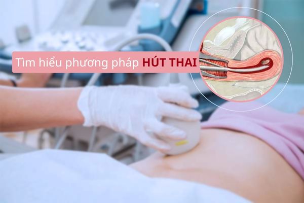 Hút thai an toàn là như thế nào? Cần lưu ý gì khi thực hiện?