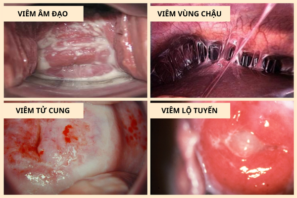 huyet-trang-mau-nau-dau-hieu-canh-bao-nguy-hiem-1