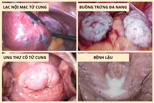 huyet-trang-mau-nau-dau-hieu-canh-bao-nguy-hiem-2