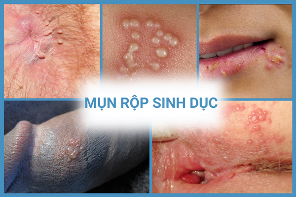 nhung-thong-tin-can-luu-y-ve-benh-xa-hoi-o-nam-va-nu-3
