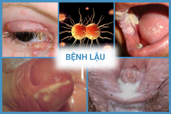 nhung-thong-tin-can-luu-y-ve-benh-xa-hoi-o-nam-va-nu-5