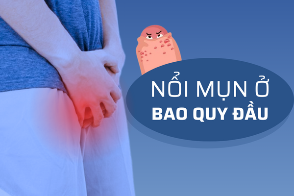 Nổi mụn ở bao quy đầu – nguyên nhân và cách giải quyết hiệu quả