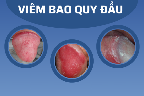 noi-mun-o-bao-quy-dau-nguyen-nhan-va-cach-giai-quyet-hieu-qua-1