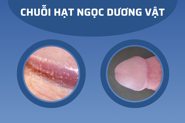 noi-mun-o-bao-quy-dau-nguyen-nhan-va-cach-giai-quyet-hieu-qua-2