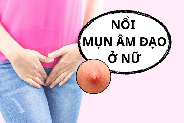 Cẩn thận khi bị nổi mụn âm đạo ở nữ