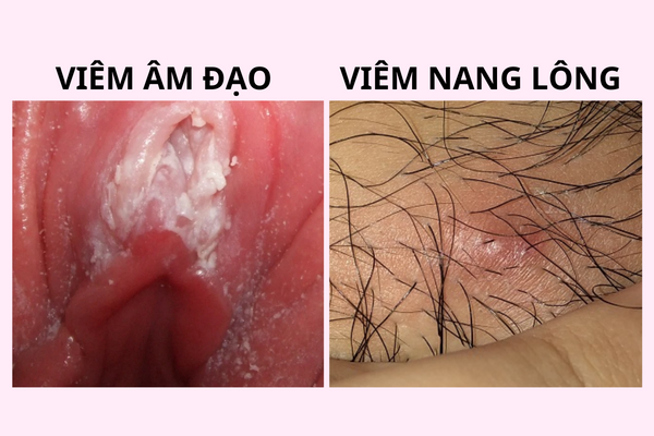 can-than-khi-bi-noi-mun-am-dao-o-nu-1