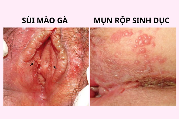can-than-khi-bi-noi-mun-am-dao-o-nu-2