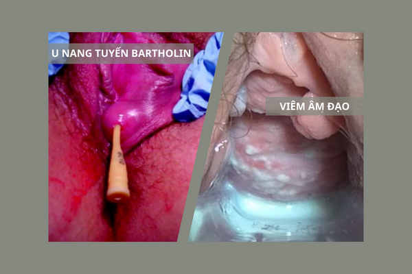 canh-bao-tinh-trang-noi-hach-o-mep-am-dao-1