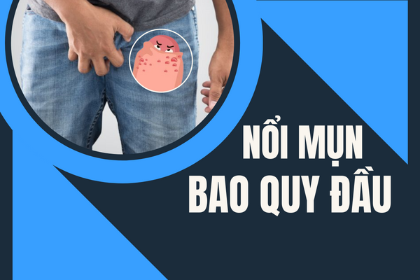Nổi mụn bao quy đầu cảnh báo điều gì?