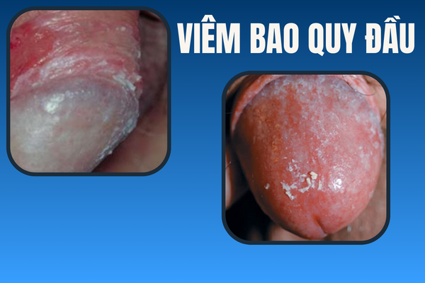 noi-mun-bao-quy-dau-canh-bao-dieu-gi-2